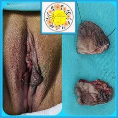 Vaginoplastia - Dr. Javier Nicolía