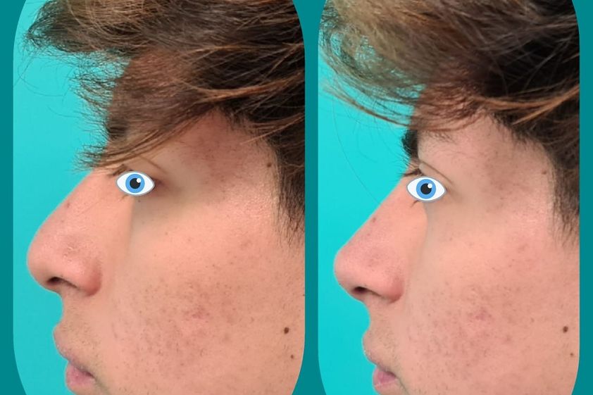 Rinomodelación antes y después - 790494