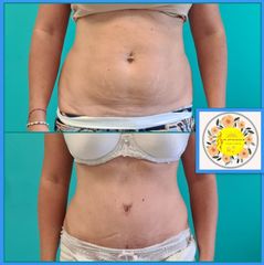 Lipo-Abdominoplastia - Dr. Javier Nicolía - Centro Médico Palmares