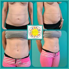 Lipo-Abdominoplastia - Dr. Javier Nicolía - Centro Médico Palmares