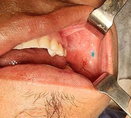 Bichectomia - Dr. Javier Nicolía - Centro Médico Palmares