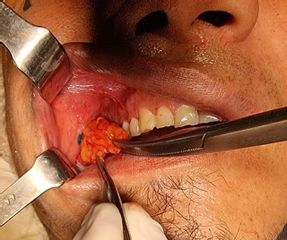 Bichectomia - Dr. Javier Nicolía - Centro Médico Palmares