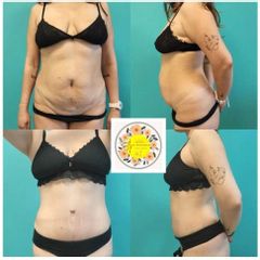 Liposucción - Dr. Javier Nicolía - Centro Médico Palmares