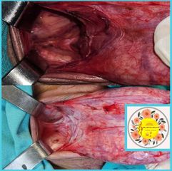 Faloplastia - Dr. Javier Nicolia