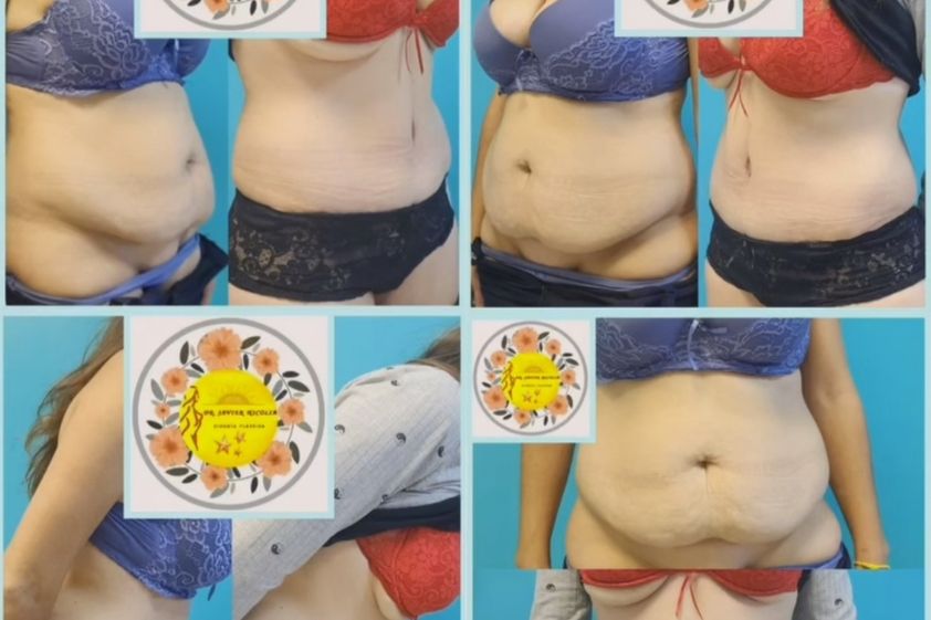 Abdominoplastía antes y después - 853562