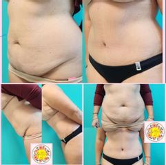 Lipo.Abdominoplastia - Dr. Javier Nicolía - Centro Médico Palmares