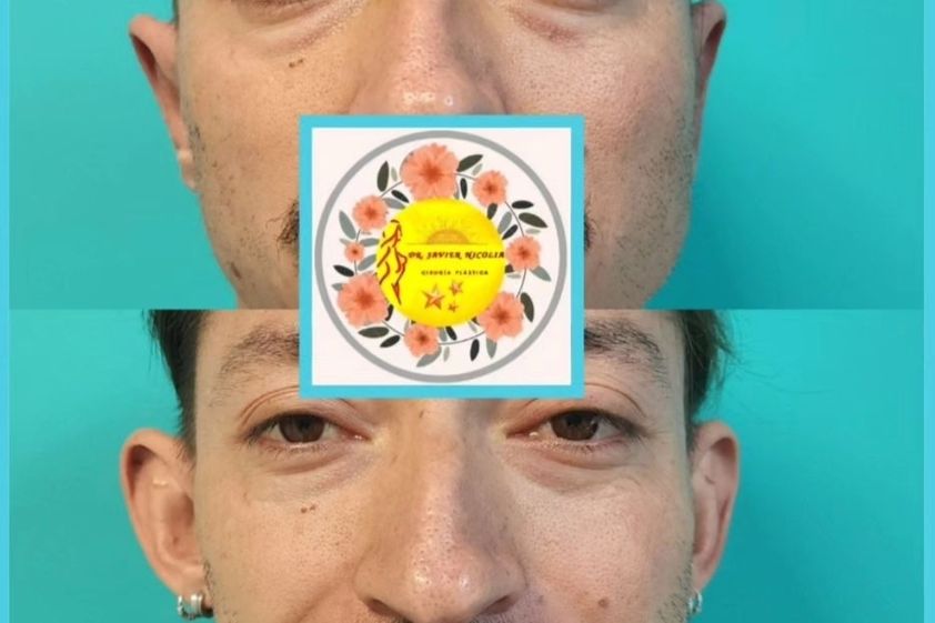 Otoplastia antes y después - 853566