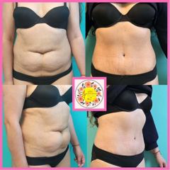 LIPO-ABDOMINOPLASTIA - Dr. Javier Nicolia Centro Medico Palmeras