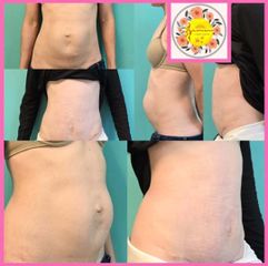 MINI-ABDOMINOPLASTIA - Dr. Javier Nicolia Centro Medico Palmares