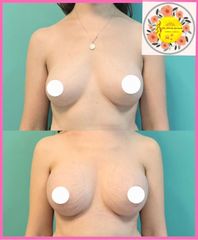 Aumento Mamario - Dr. Javier Nicolia Centro Medico Palmares
