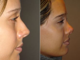 Rinoplastia antes y después - 875322