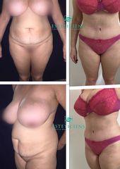 Abdominoplastia 