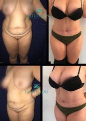 Obtene abdomen plano con una dermolipectomia 