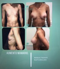 Dra. Mariana Bouvier - Aumento mamas