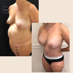 Dermolipectomía - Dra. Mariana Bouvier