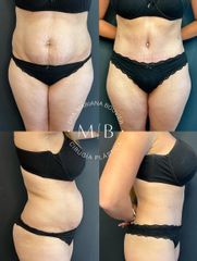 Abdominoplastia - Dra. Mariana Bouvier