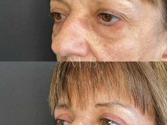 Blefaroplastia antes y después - 875788