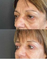 Blefaroplastia - Dra. Mariana Bouvier