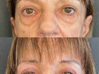 Blefaroplastia antes y después - 875789