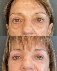 Blefaroplastia - Dra. Mariana Bouvier