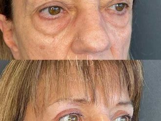 Blefaroplastia antes y después - 875790