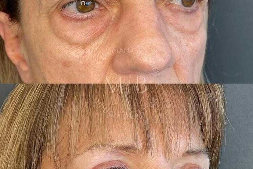 Blefaroplastia antes y después - 875790