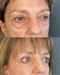 Blefaroplastia -Dra. Mariana Bouvier