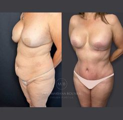 Mommy Makeover -Dra. Mariana Bouvier