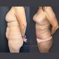 Mommy Makeover -Dra. Mariana Bouvier