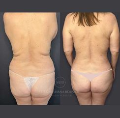 Mommy Makeover -Dra. Mariana Bouvier