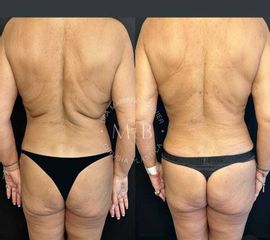 Liposucción - Dra. Mariana Bouvier