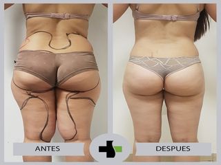 lipoescultura