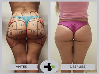 Liposucción 