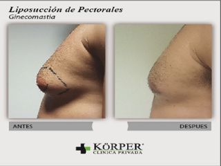 liposuccion de Pectorales 