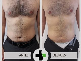 LIPOSUCCION