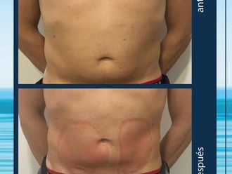 Criolipólisis antes y después - 645137