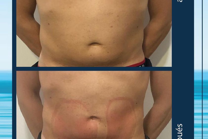 Criolipólisis antes y después - 645137