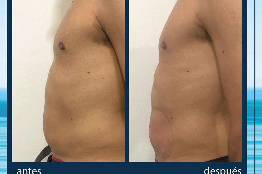 Mesoterapia antes y después - 645139