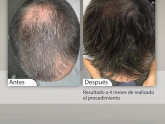 Implante capilar - 647711
