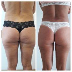 Lipoescultura + Aumento Gluteos - Dr. Lisandro Gianello