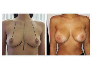 Aumento mamas - Dr. Lisandro Gianello