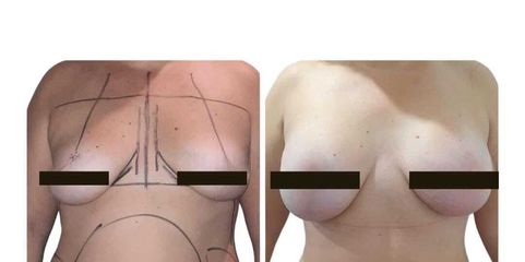 Aumento mamario - Dr. Lisandro Gianello
