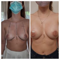 Aumento de mamas - Dr. Lisandro Gianello