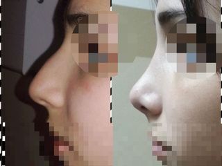 Cirugía de nariz Dra. Solimano