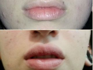 Aumento de labios
