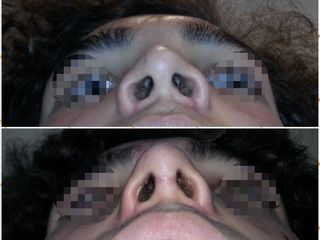 Agostamiento de base nasal ancha