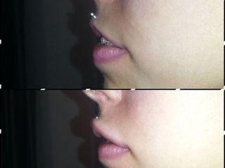 Aumento de labios Dra Solimano 
