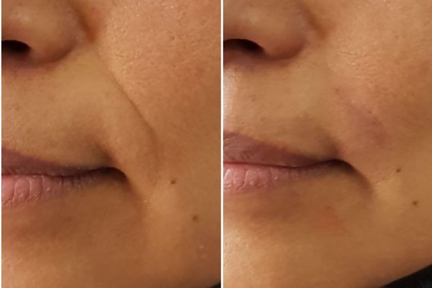 Rejuvenecimiento facial antes y después - 624164