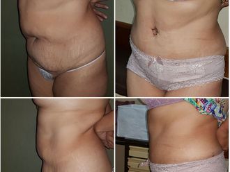 Abdominoplastía - 635552