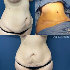 Abdominoplastía - Dra. Natalia Solimano